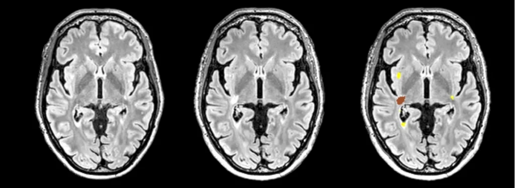 تصویر MRI مغز در تشخیص مولتیپل اسکلروزیس با هوش مصنوعی